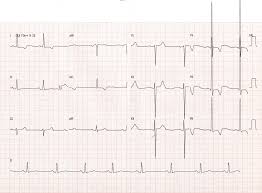 Presented is an example of ecg abnormalities encountered during immune checkpoint inhibitor myocarditis. Prova De Titulo Em Cardiologia Insuficiencia Cardiaca Ecg Com Baixa Voltagem Pensar Em
