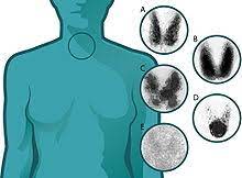 • although a monobacterial etiology, typically clostridium and streptococcus group a, can be found, the. Thyroid Disease Wikipedia