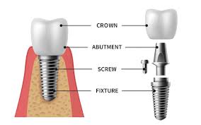 Image result for dental implant