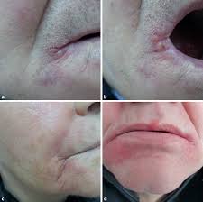 Image result for Angular Cheilitis