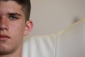 Acne Adolescente Soluciones Madres Hoy