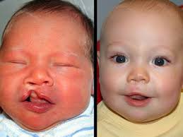 Dr Albert Woo Director Of The Craniofacial Institute At St Louis Children S Hospital Has Pioneered A Surgical Te Cleft Lip And Palate Cleft Lip Cleft Palate