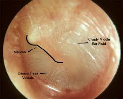 Being prone to ear infections can run in families.; Middle Ear Infection Images Mcgovern Medical School