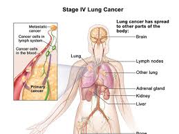 Many of the signs and symptoms can also be caused by other medical conditions but finding lung cancer early can mean that it's easier to treat. First Line Immunotherapy Treatment Can Improve Survival For Subset Of Lung Cancer Patients