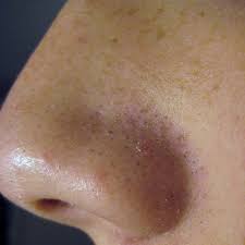 #blackhead #getrid #home #nose #remedies #remove. Sebaceous Filament Wikipedia