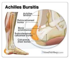 Achilles Bursitis The Most Common Bursa To Be Inflamed In The Foot Is The Retrocalcaneal Bursa Also Referred Achilles Tendonitis Achilles Bursitis Bursitis