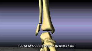 Ayak Bilegi Kiriklari Hakkinda Bilinmesi Gerekenler Youtube