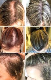 Unexplained, excessive hair loss can be worrying and scary but the good news is, there's often a way to fix it. Women And Hair Loss Causes Solutions And Support First Thyme Mom