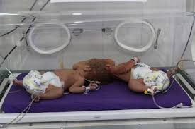 ولادة توأم سيامي ملتصق الرأس بحضرموت Children Pacifier Yemen