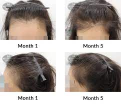 Hair growth supplements to make facial hair grow. Hair Growth Success Story Thank You Very Much