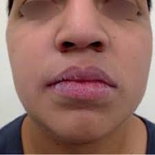 Ultrasonogram of the left submandibular gland, small salivary stone...