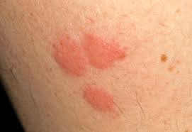 Bug Bite With Black And Blue Ring Around It Bed Bug Bites Children S Hospital Colorado