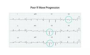 Image result for R Wave