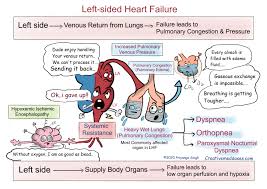 Image result for Right Heart Failure