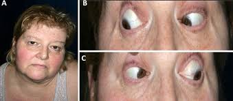 Trochlear nerve palsy