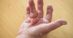 Check spelling or type a new query. 8 Surprising Dupuytren S Contracture Facts Causes Treatment