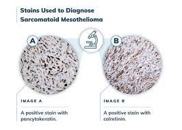 We did not find results for: Sarcomatoid Mesothelioma Prognosis Treatment Diagnosis