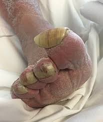Image result for Onychogryphosis feet