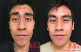 No commitment or fees to use goodrx. Botox Before After Photos Patient Photo Pictures