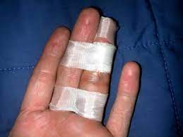 You will probably have to wear a splint or cast to immobilize the finger while it heals and, depending on the severity of the break, this can take three to six weeks. Broken Finger Treatment And Recovery