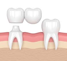 Dental Bridges 3 Amazing Benefits | Dentists Gold Coast & Brisbane