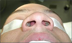 Nasal polyps might not need treatment because they often clear on their own. Swollen Masses In The Nose Photo Quiz American Family Physician