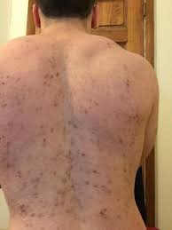 Blocks acne triggers & promotes healthy cell growth. Acne I Have Been On Accutane For 4 Months And My Bacne Hasn T Got Any Better Starting To Lose A Lot Of Confidence Wondering If I Could Do Anything Along With Accutane