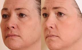 We did not find results for: Best Halo Hybrid Fractional Laser Treatments Tucson Az