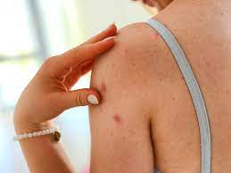 Skin cancer is by far the most common type of cancer. A List Of Common Skin Bumps And Signs They Could Be Dangerous