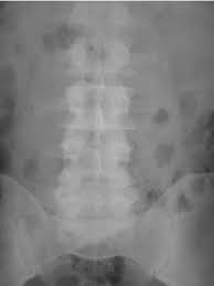 Patient Presented With Left Loin Pain Kidney Ureter And Bladder Kub Download Scientific Diagram