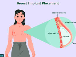 Check spelling or type a new query. Breast Implants For Reconstruction After Mastectomy