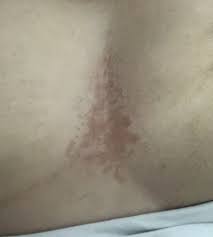 It is mostly a form of irritant dermatitis and is called intertrigo here are the top 10 ways to get rid of a rash under your breasts. Redness Between Breasts With Pics Babycenter