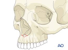 Check spelling or type a new query. Classification Of Nasal Bone Fractures