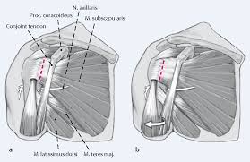 One tendon might have it worse, but it's never isolated to just one tendon. Figure 2 From Open Reconstruction Of The Anterior Glenohumeral Capsulolabral Structures With Tendon Allograft In Chronic Shoulder Instability Semantic Scholar