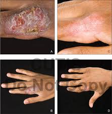 A18.48) is een rechtstreekse reactie op de infectie en onstaat op en rond de plek waar de bacterie de huid is binnengedrongen. Pdf Nonhealing Vegetating Plaque On The Finger Tuberculosis Verrucosa Cutis Semantic Scholar