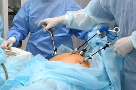 Laparoscopic bariatric surgery