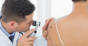 Znamiona, pieprzyki, plamki, piegi. Czy są groźne? - Zdrowie w INTERIA.PL