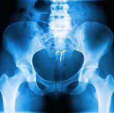 We did not find results for: Woman S Iud Moves To Abdomen 11 Years Later Signs To Watch For