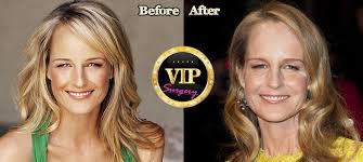 Plastic surgery has become a norm these days. Helen Hunt Plastic Surgery