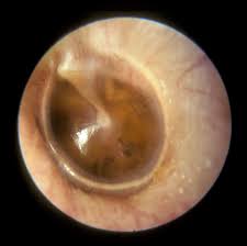 Acute suppurative otitis media is the most common infection of childhood except for acute upper respiratory tract infections. Acute Otitis Media In Adults Suppurative And Serous