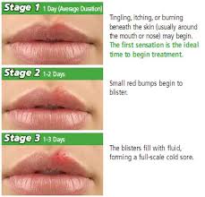 Cooling the skin with a cold, moist cloth. How Soon Does Herpes Appear On Mouth Tyth Cure Me Site