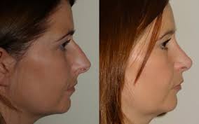 What is the recovery process after nose job surgery? Nose Job Rhinoplasty Quaba Plastic Surgery Edinburgh Scotland
