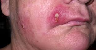 They often develop around open sores, but also happen on intact skin. Staph Infection Symptoms Causes Treatment Staphylococcus Aureus