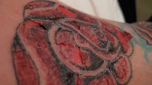 Tattoo Infection Symptoms And Treatment