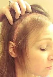 Bleeding into the cerebrospinal fluid (csf) around the brain (also called a subarachnoid hemorrhage) Kaley S Story What To Do When Facing An Unruptured Aneurysm The Bee Foundation