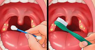 Home remedies to get tonsil stones out without gagging (gag reflex) 11 Tips For Removing Tonsil Stones That Ll Make You Sigh With Relief
