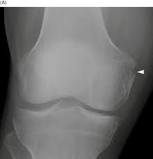 It can occur from any activity involving use of the arms or. Fractures And Dislocations Of The Femur Chapter 10 Broken Bones