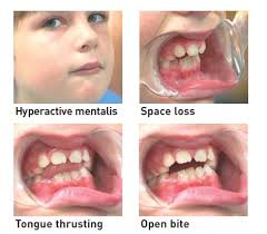 How to correct overbite naturally. Alternative Or Myofunctional Orthodontics