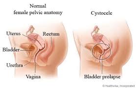 Bladder Prolapse Cystocele Bladder Prolapse Pelvic Organ Prolapse Bladder