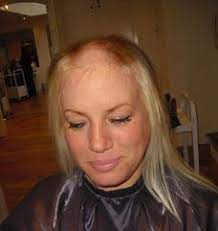 Stress can also affect your sex hormones which will affect hair growth. Stress Heartbreak And Hair Loss In Women